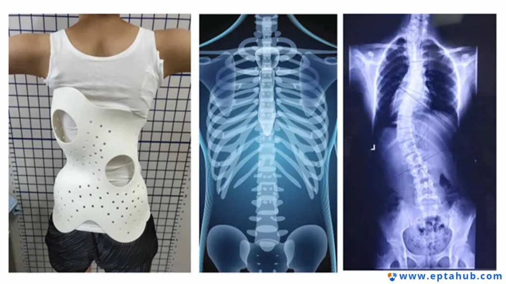 Uma imagem em três painéis mostra como a SLS é usada para dispositivos médicos personalizados, comparando a radiografia de escoliose de um paciente (à direita) com um colete ortopédico personalizado, impresso em 3D (à esquerda), projetado para corrigi-la.